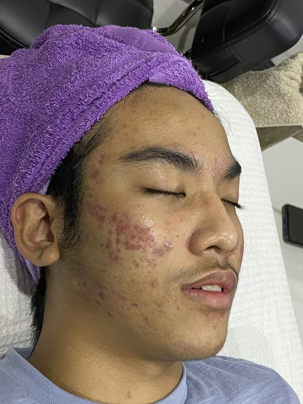 Quelle routine de soins adopter pour les peaux sujettes à l'acné hormonal?